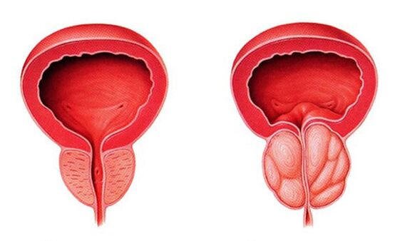 Próstata normal e inflamada (prostatite)