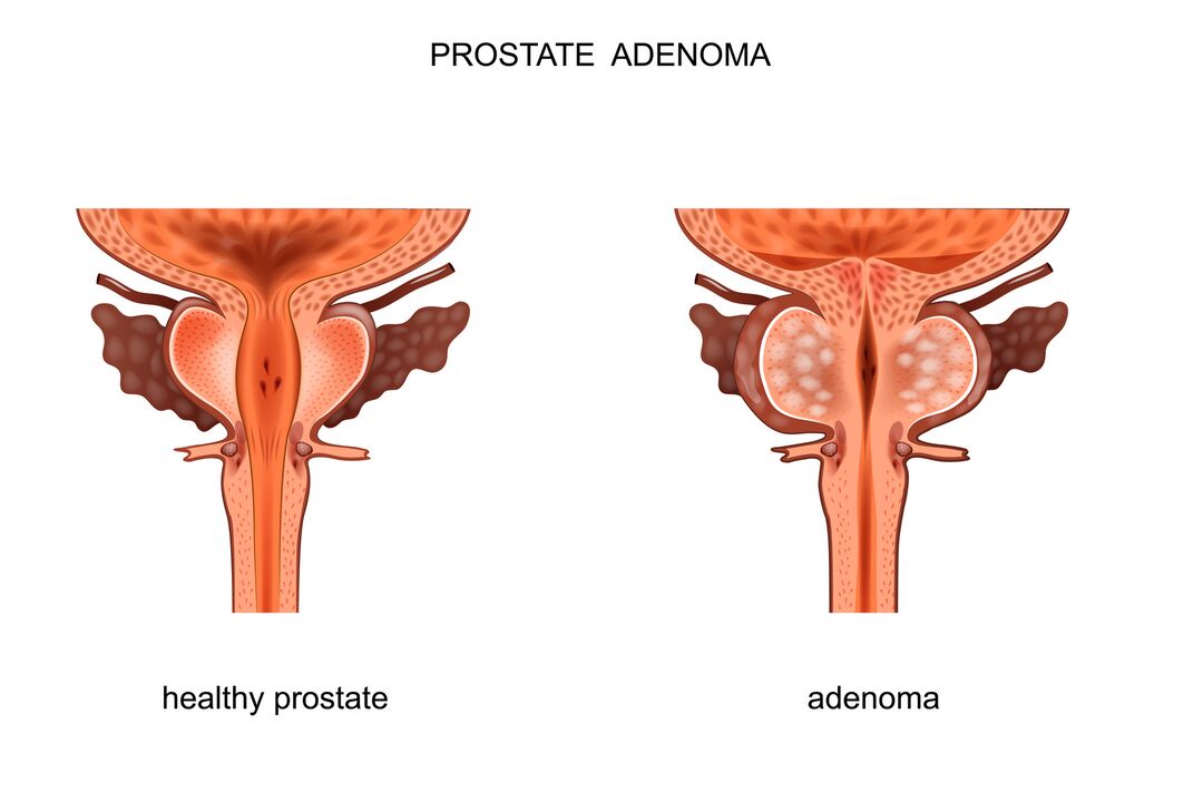 Próstata saudable e adenoma