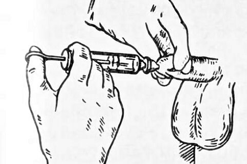 Instilacións para prostatite