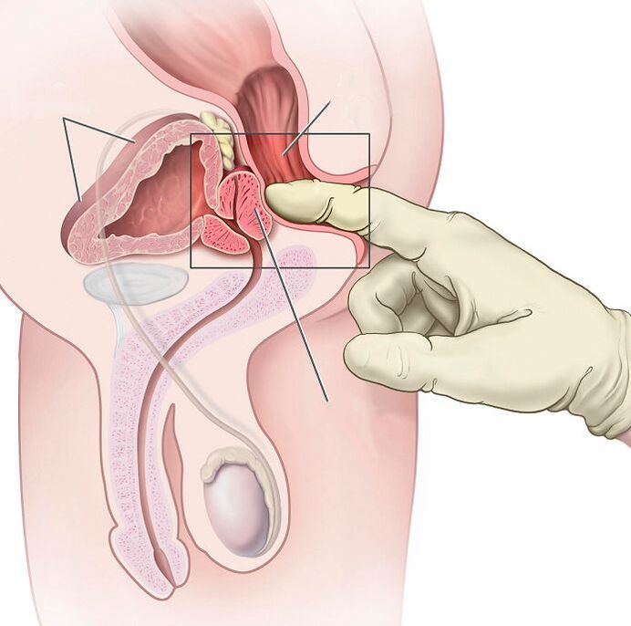 Masaxe prostática para tratar a prostatite