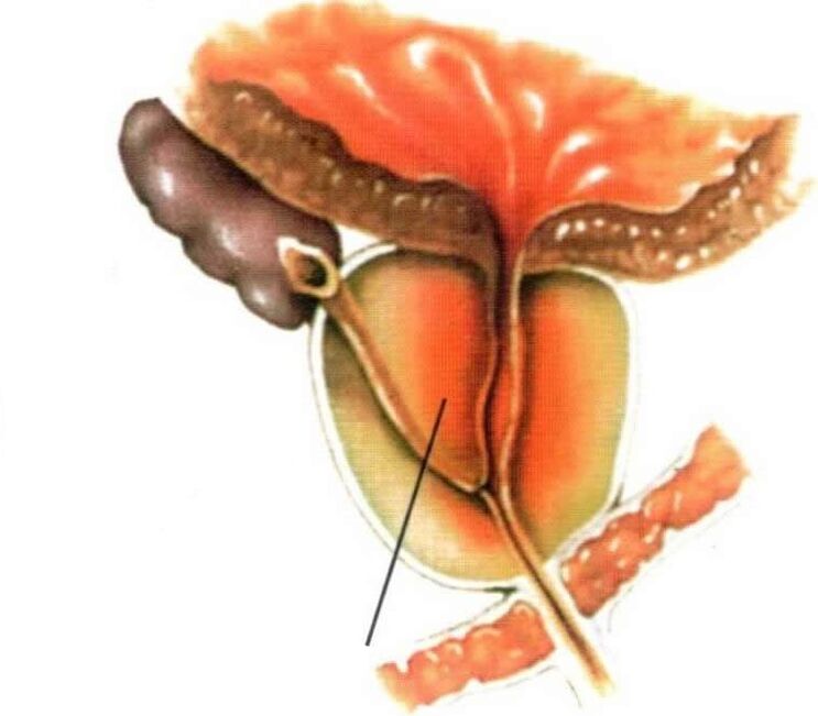 Inflamación do tecido prostático na prostatite crónica